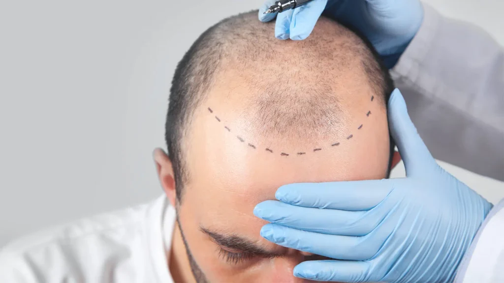 Haarpigmentierung bei Haarausfall – natürliche optische Verdichtung bei dünner werdendem Haar