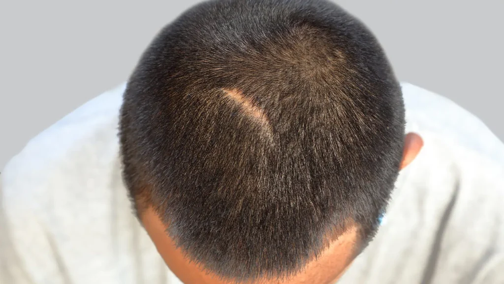 Haarpigmentierung bei Narben – natürliche optische Kaschierung von Narbenbereichen