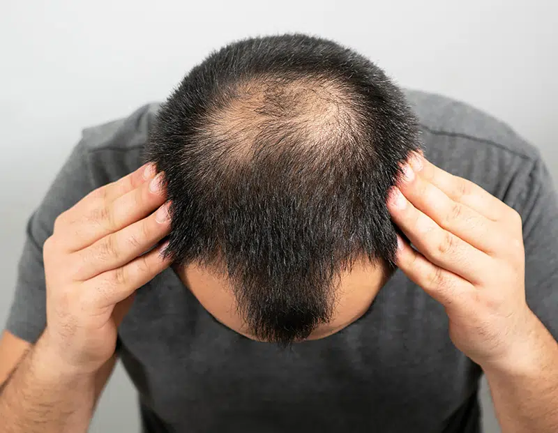 Optic Hair Berlin Preise – Haarpigmentierung für kleine Flächen zu transparenten Konditionen