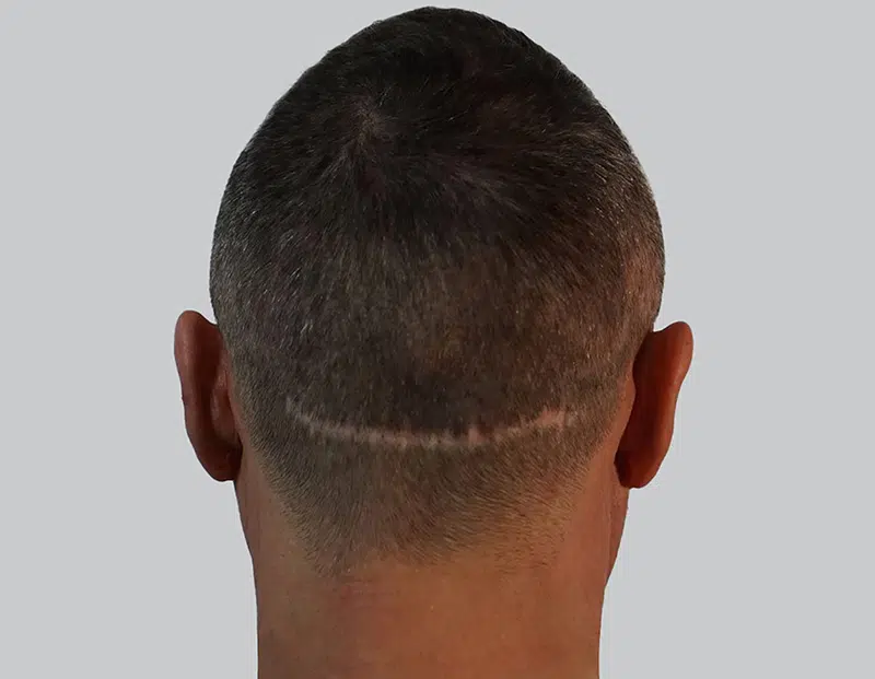 Optic Hair Berlin Preise – Haarpigmentierung zur Narbenkaschierung zu transparenten Konditionen