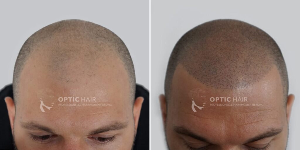 Beste Haarpigmentierung vorher nachher – hochwertiges Ergebnis mit natürlicher Wirkung