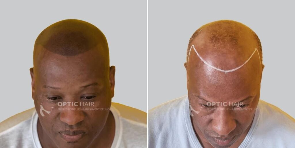 Haare pigmentieren vorher nachher – sichtbarer Unterschied durch professionelle Haarpigmentierung mit natürlichem Look