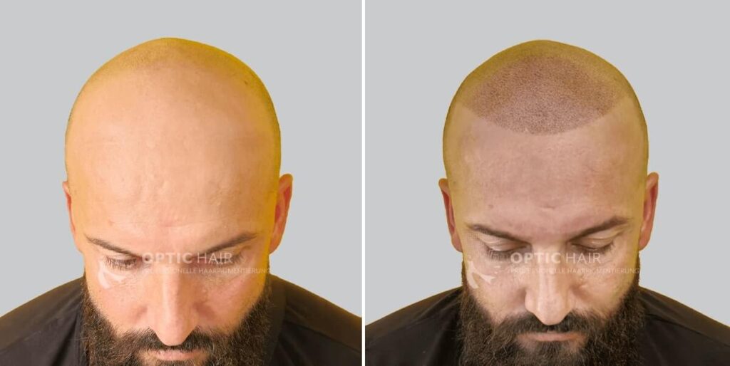 Haare pigmentieren – natürliches Ergebnis der professionellen Haarpigmentierung für mehr optische Haardichte