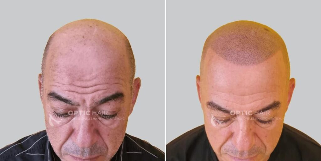 Haare pigmentieren bei Glatze vorher nachher – sichtbarer Unterschied durch professionelle Kopfhautpigmentierung