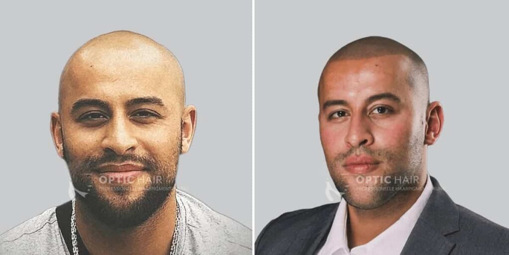 Haare pigmentieren vorher nachher in Berlin – sichtbares Ergebnis der professionellen Haarpigmentierung