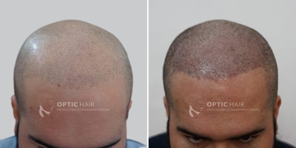 Haarpigmentierung vorher nachher in Berlin – professionelles Ergebnis der Kopfhautpigmentierung mit natürlicher Wirkung