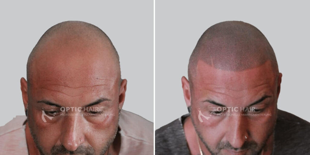 Haarpigmentierung vorher nachher in Berlin – natürliches Ergebnis mit sichtbarer Verdichtung