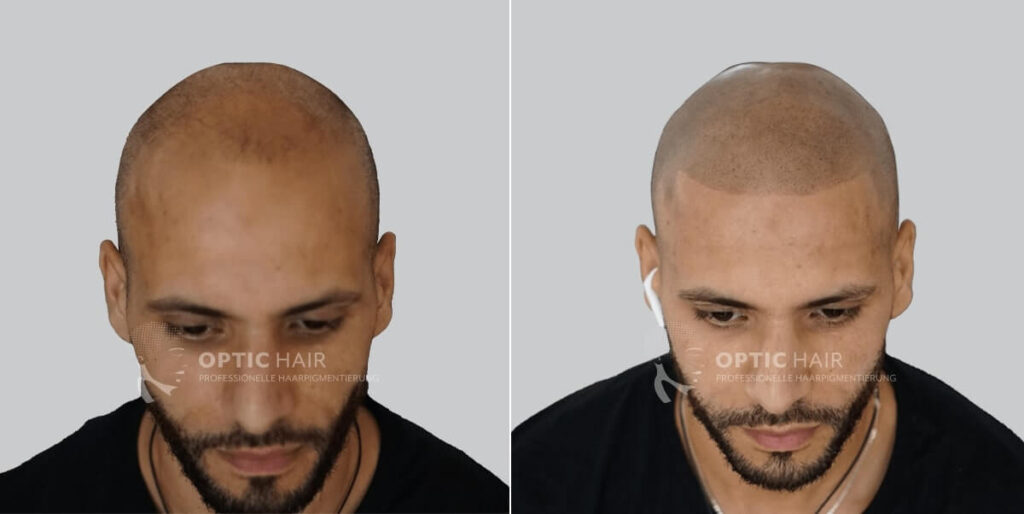 Haarpigmentierung bei Glatze vorher nachher – gleichmäßiger, natürlich wirkender Look durch Kopfhautpigmentierung