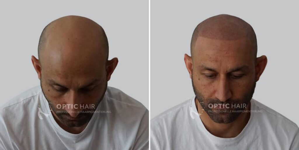Haarpigmentierung vorher nachher in Köln und Berlin – professionelle Kopfhautpigmentierung mit natürlichem Ergebnis