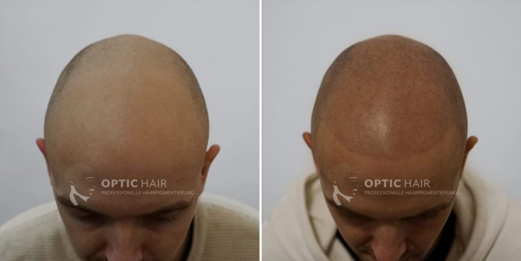 Haarpigmentierung vorher nachher in Köln – natürliches Ergebnis der Behandlung