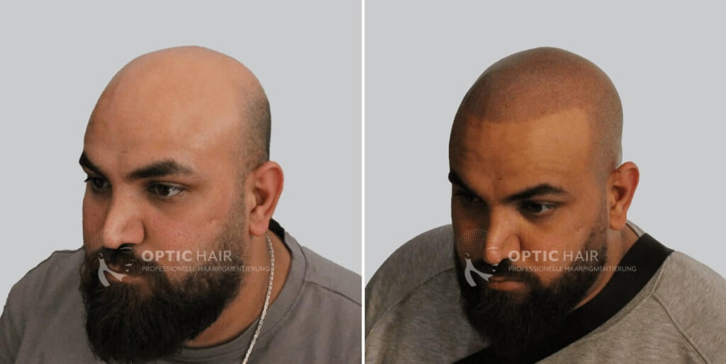 Haarpigmentierung Optic Hair – natürliches Ergebnis der professionellen Kopfhautpigmentierung bei OpticHair