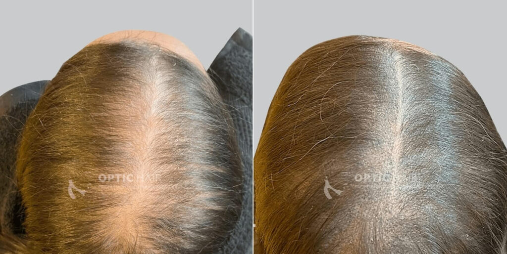 Haarpigmentierung bei Frauen vorher nachher – natürliche Verdichtung mit harmonischem Ergebnis