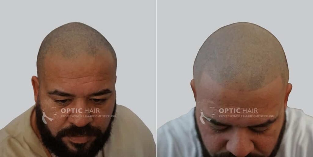 Haarpigmentierung mit natürlicher Haarlinie – harmonisches und authentisches Ergebnis