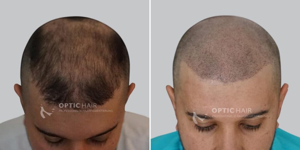 Haarpigmentierung vorher nachher – sichtbares Ergebnis mit natürlicher Wirkung