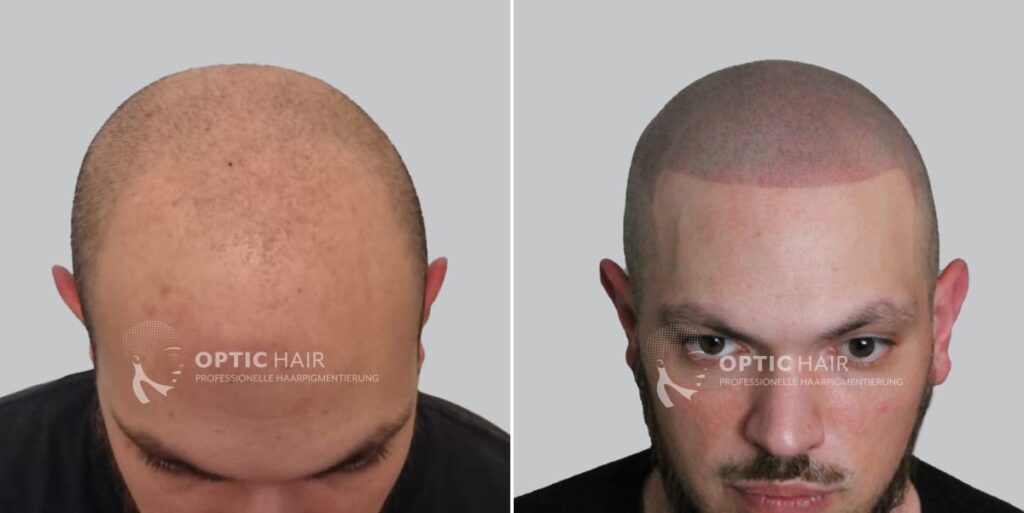 Haarpigmentierung vorher nachher – Ergebnis nach der dritten Sitzung mit natürlicher Wirkung