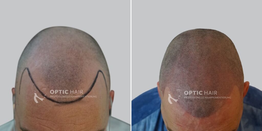 Haarpigmentierung vorher nachher – natürlich geformte Haarlinie mit harmonischem Ergebnis