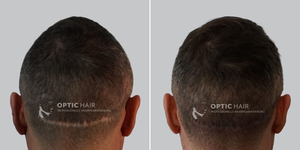 Haarpigmentierung vorher nachher – Narben kaschieren durch professionelle Kopfhautpigmentierung mit natürlichem Ergebnis