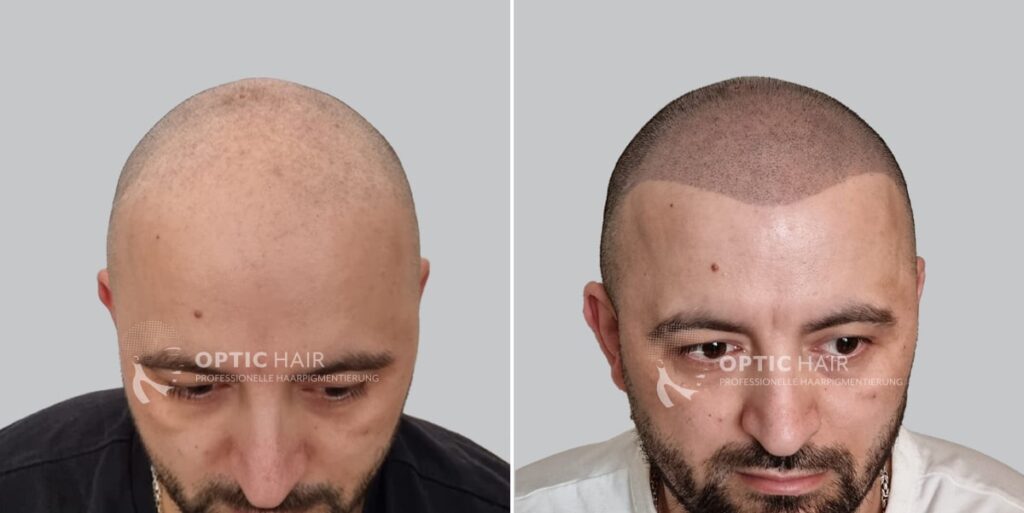 Haarpigmentierung vorher nachher – Resultat der professionellen Kopfhautpigmentierung mit natürlichem Erscheinungsbild