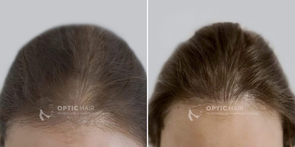 Haarpigmentierung vorher nachher bei Frauen – natürliche optische Verdichtung durch professionelle Kopfhautpigmentierung