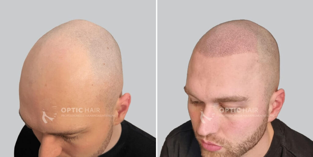 Haarpigmentierung vorher nachher bei Glatze – natürlich wirkender Look durch professionelle Kopfhautpigmentierung
