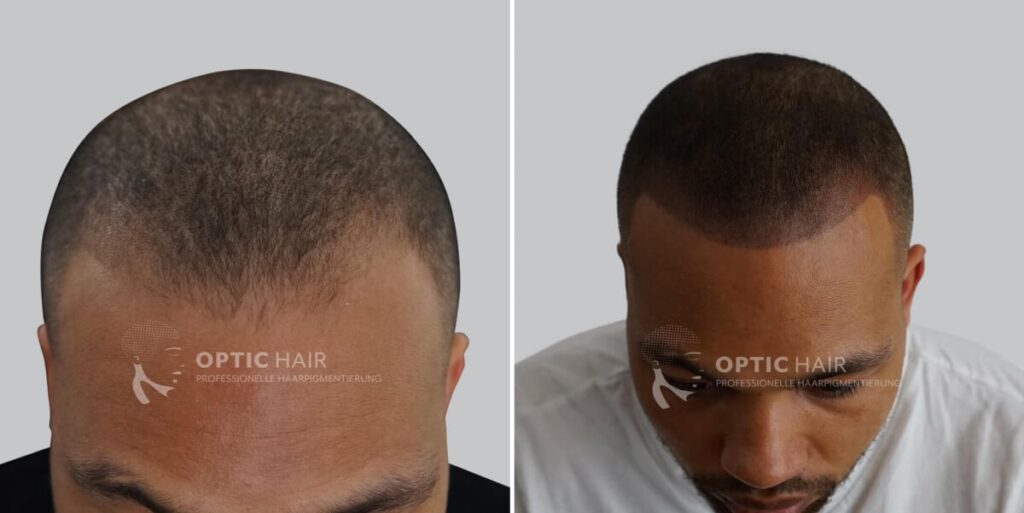 Haarpigmentierung vorher nachher bei Haarausfall – natürlich wirkende optische Verdichtung