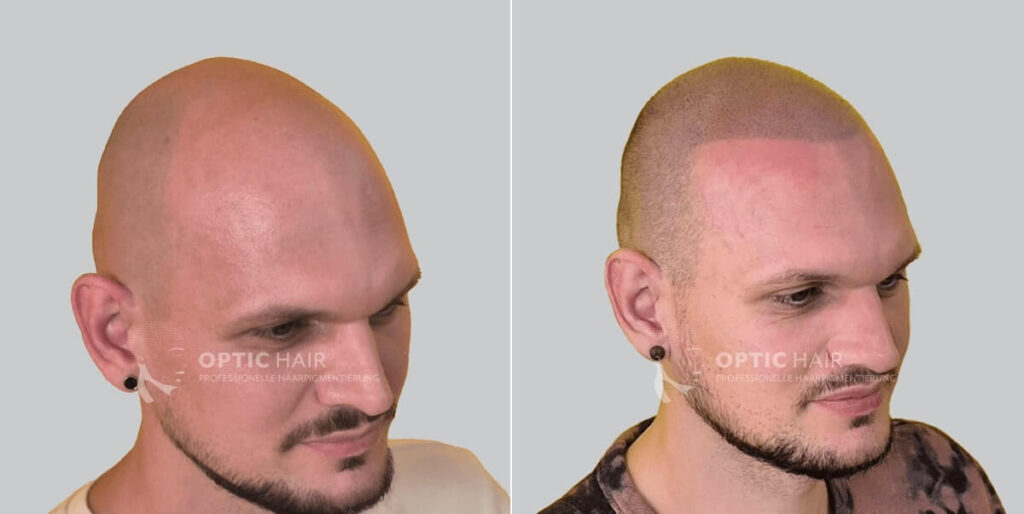 Haarpigmentierung vorher nachher in NRW – professionelle Kopfhautpigmentierung mit natürlichem Ergebnis