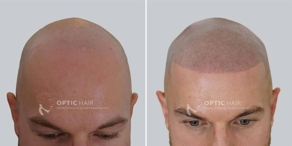 Haarpigmentierung vorher nachher – Erfahrungen und sichtbares Ergebnis nach der Behandlung