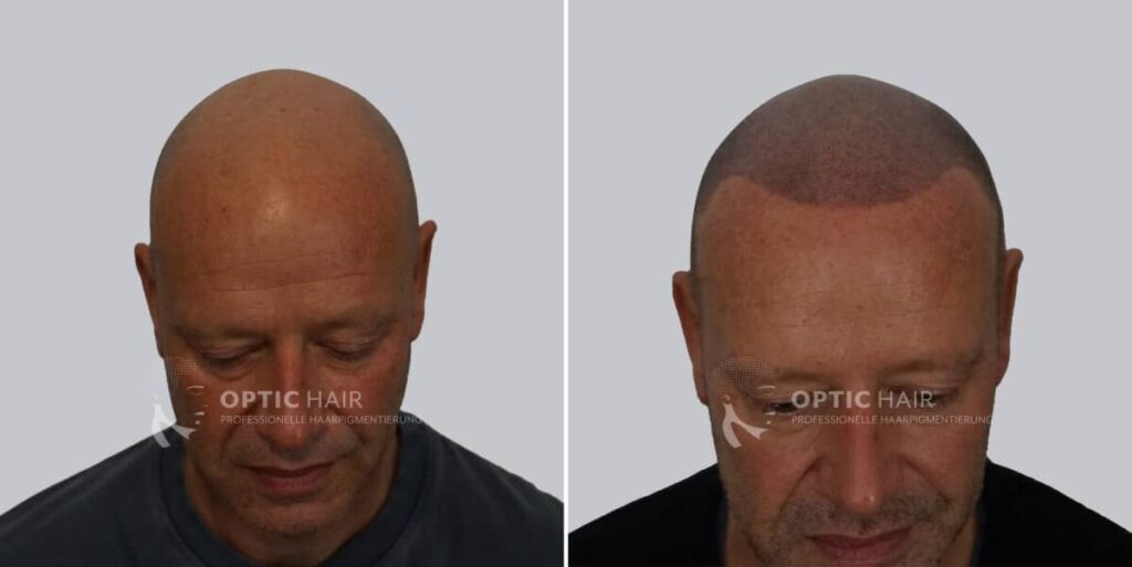 Haarpigmentierung vorher nachher – dichtes Ergebnis mit natürlicher Wirkung