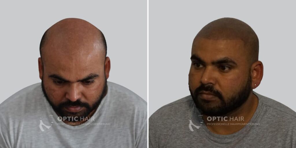 Haarpigmentierung vorher nachher – natürliches Ergebnis ohne sichtbare Übergänge