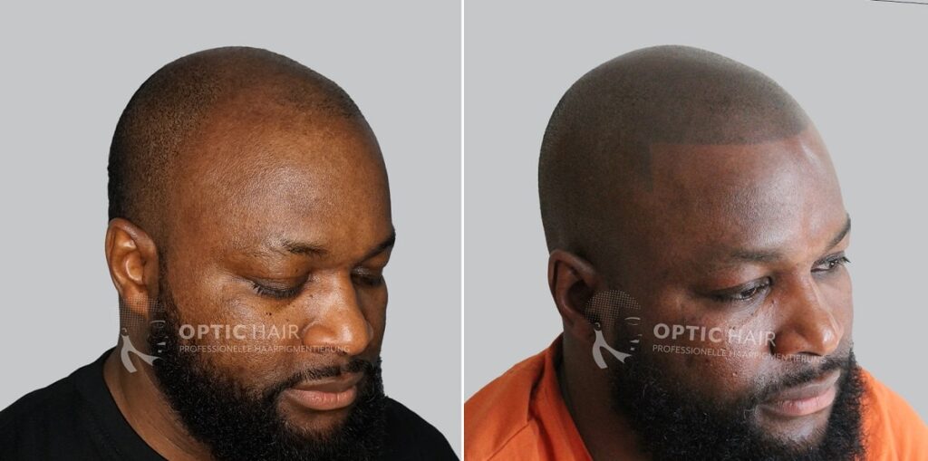 Nano-Haarpigmentierung vorher nachher – präzises, natürlich wirkendes Ergebnis