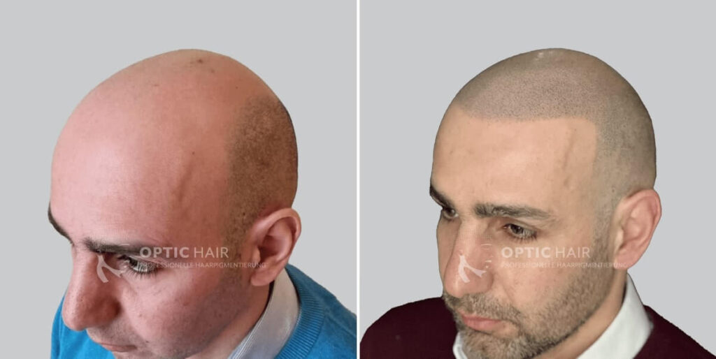 Optic Hair Haarpigmentierung vorher nachher – natürliches Ergebnis der Behandlung