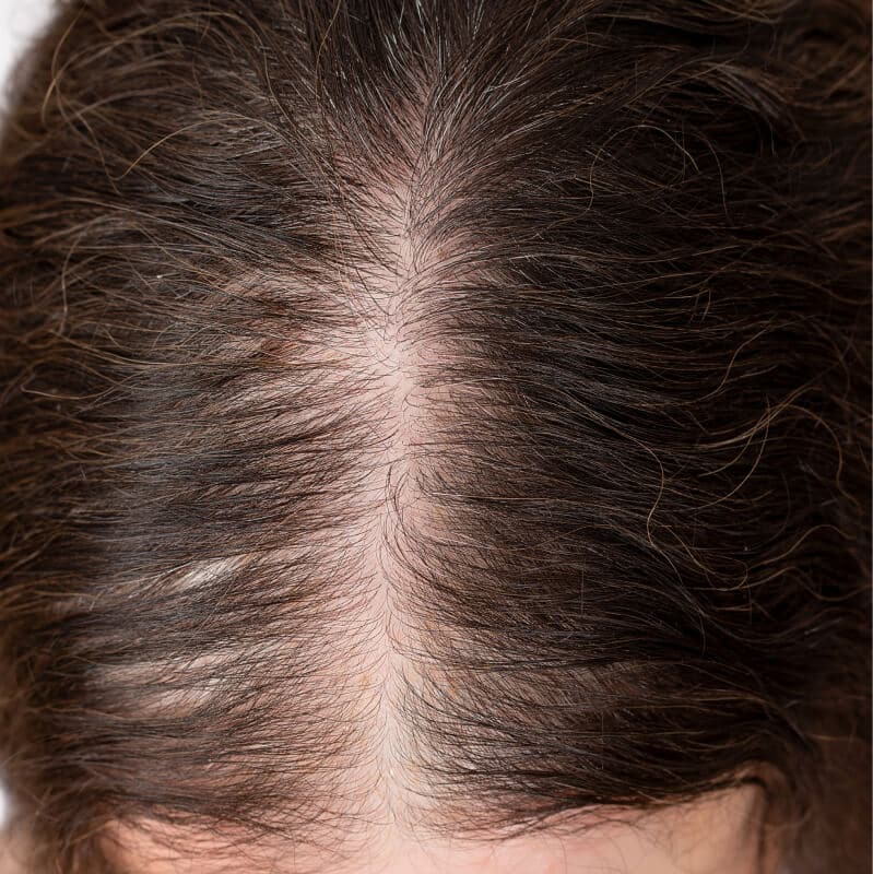 Überwiegend diffuser Haarausfall bei Frauen – gleichmäßige Ausdünnung des Haares vor der Behandlung