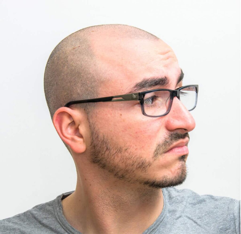 Vorher-Nachher-Bilder als wichtiges Qualitätskriterium – Vergleichsergebnisse der Haarpigmentierung mit natürlichem Look